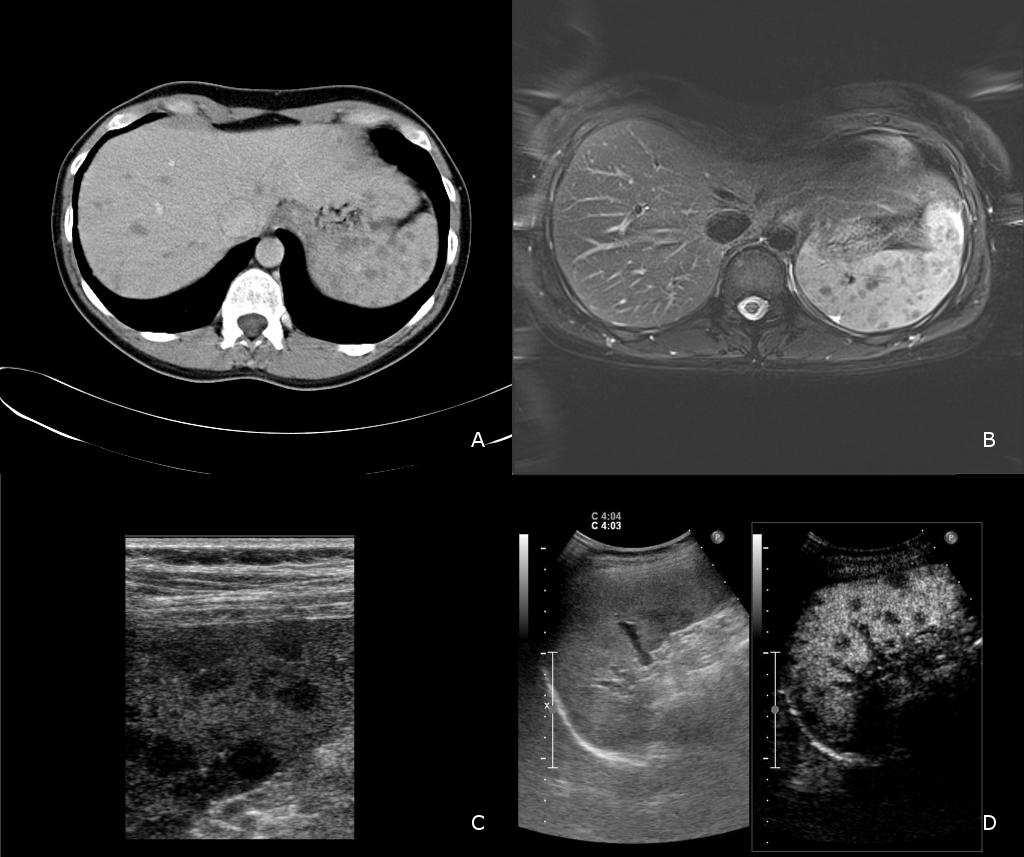 Figure 1: A: A double-contrast multidetector CT examination of the abdomen demonstrates multiple irregular hypo-intense nodules (+/- 60 UH at the venous phase) in the liver and the spleen, suggestive