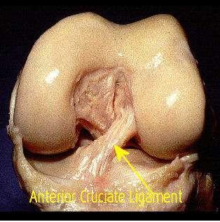 4. ACL Injuries Up to 50% of ACL injuries occur in a
