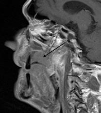 U T1 i T2 mjerenoj slici izostaje hipointenzivan signal koštanih rubova, a širenjem prominira u usnu šupljinu i u dno