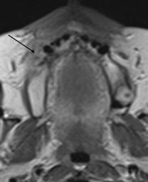 MR prikaz planocelularnog karcinoma tvrdog nepca: Postkontrastna T1 mjerena slika u aksijalnom (a), koronarnom (b) i 2.