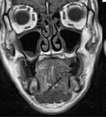 MR prikaz planocelularnog karcinoma gingive mandibule: Postkontrastna T1