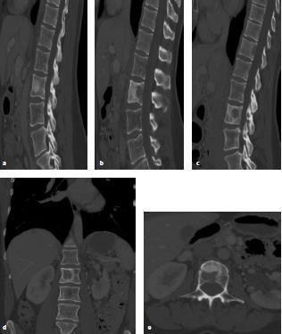 Spinal Instability Neoplastic Score (SINS) Mobile No pain Mixed Normal alignment No