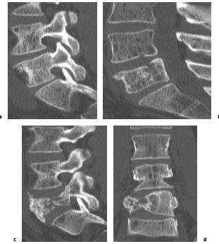 Spinal Instability Neoplastic Score (SINS)