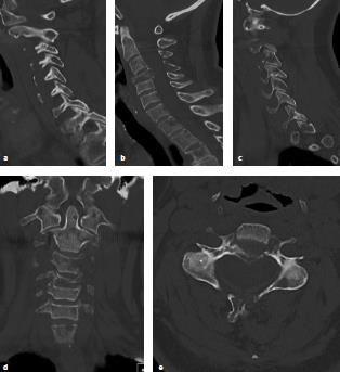 Spinal Instability Neoplastic Score (SINS) Mobile Mech pain Lytic Kyphotic > 50%