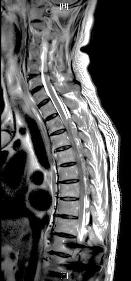 67 M Ca Prostate mets Presented with acute neurology and 1 week history of back pain Posterior