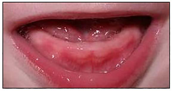90% are true primary teeth Most are poorly formed Etiology: unknown or a it can be a superficially positioned toothbud