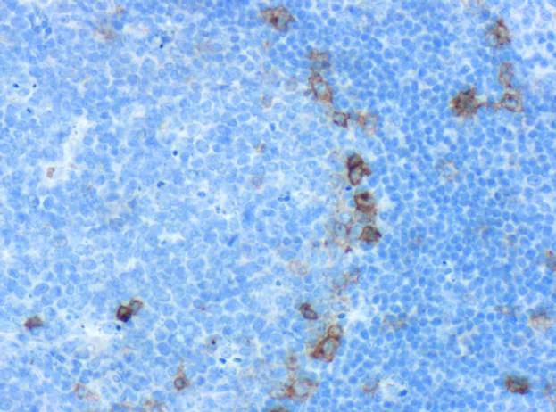 Basic stain: CD30 TNF-R family Ki-1 antigen Activation antigen Normal expression: activated parafollicular immunoblasts virally