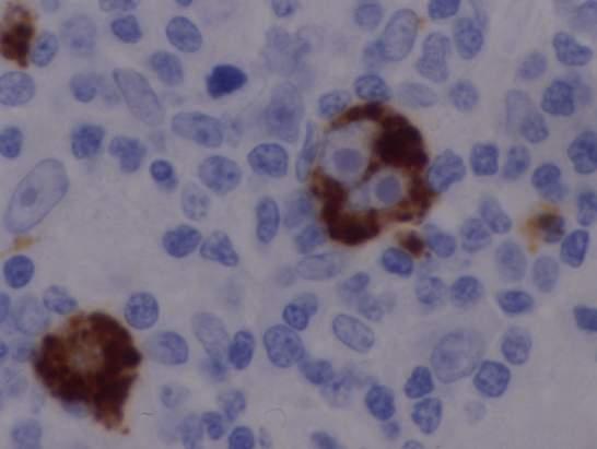 Secondary stain: EBV Most viral antigens not relevant Latent membrane protein 1 Normal primary infection (IM) Latency patterns II and III HRS-cell-like morphology EBNA2 Nuclear reaction Normal