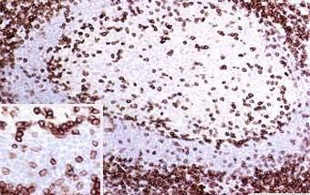 Basic stain: CD3 transmembrane molecule Ig superfamily part of T-cell receptor most specific T-cell marker pan-t
