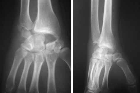 (a) preoperative anteroposterior and lateral views showing radiocarpal arthritis ; (b) postoperative radiograph showing the proximal position of the capitate bone after excision of the proximal