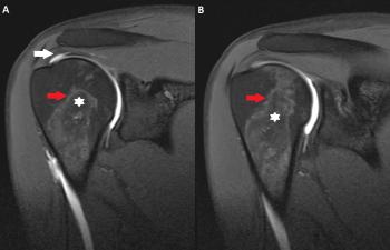 MR arthrography, coronal fs T1-WI (A and B): irregularity in the supraspinatus (white arrow), bone marrow abnormalities in