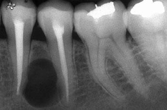 CASE REPORT point of obstruction and the teeth were sealed coronally with enamel and dentine bonded composite resin. A radiograph was taken to check the quality of root canal treatment.