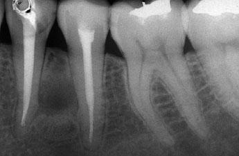No clinical symptoms were reported. At the 2-year follow-up, the teeth were functionally stable, with no loss of periodontal attachment but the patient complained of occasional pain on chewing.