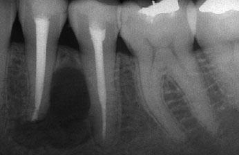 CASE REPORT Figure 4 Periapical radiograph after endodontic surgery. Histological examination revealed the presence of epithelial lining with 5 6 layers of columnar basal cells.