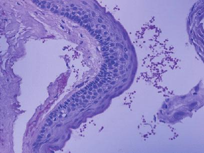 The histological diagnosis was odontogenic keratocyst (OKC) (Fig. 5). These results were presented to the patient and a second surgical procedure to treat the OKC was recommended.