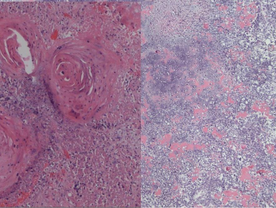 Figure 5: 65 years old male with lung mass that turned out to be bronchial carcinosarcoma.