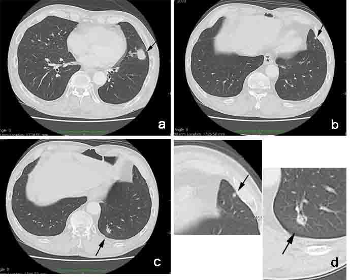Primary Lung Cancer Coexisting with Lung Metastases from Various Malignancies 21 in size after chemotherapy.