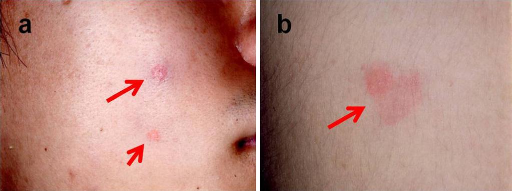 Figure 1. Pictures of the skin in the patient showing swelling with painful plaques (arrows) measuring 0.5 to 2 cm in diameter on his face (a) and shoulders (b). Figure 2.