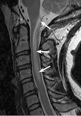 NMOSD: Spinal Cord