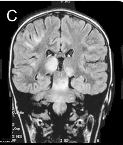 ADEM: BRAIN MRI Large multifocal, T 2 -hyperintense