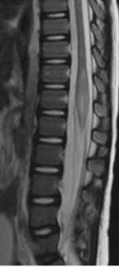ADEM: Spinal Cord MRI Spinal cord involvement has been