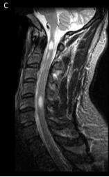 Multiple Sclerosis Spinal Cord lesion characteristics Small size: Location: Shape: < 2 vertebral segments < half of cord cross-sectional area cervical > than the rest lateral lateral + posterior