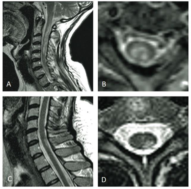 NMOSD vs MS Spinal Cord MRI NMO central lesion Long spinal cord lesion over 3 vertebral segment Trasversally extensive lesions involving the grey matter surrounding the central canal.
