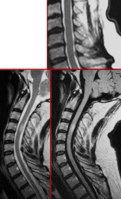 NMOSD vs MS Spinal Cord MRI Longitudinally Extensive Transverse Myelitis > 3 segments Centrally located Majority of transverse axis MS risk <2% Acute Partial Transverse