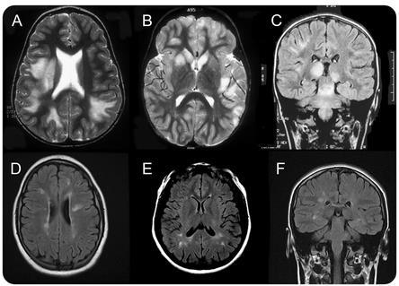 ADEM vs MS MRI