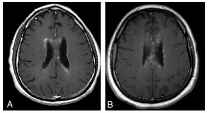 NMOSD: BRAIN MRI Enhancement pattern Brain Gadolinium enhancement is rare Frequently patchy enhancement with blurred margins ( cloudlike enhancement ) or pencil-thin ependymal enhancement (similar to