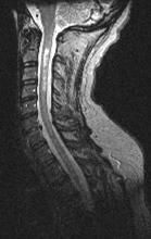 NMOSD:Spinal Cord