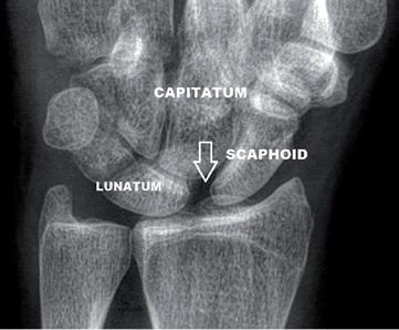 Obr. 5A Obr. 5B Obr. 5: A. Rtg. snímka: skafolunátna medzera približne 3 mm po úplnej ruptúre skafolunátnych ligament, štádium V, podľa klasifikácie EWAS. B.