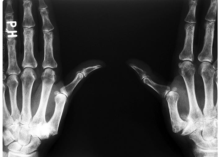 Rizartróza je artrotické postihnutie CMC kĺbu palca ruky, najčastejšie postihujúce ženy.