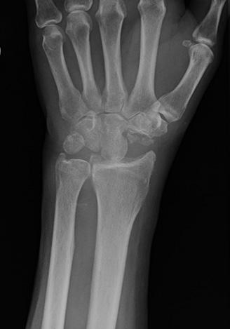 Vo včasnejších štádiách, ak je príčinou ťažkostí karpálna nestabilita, je cieľom rekonštrukcia anatomickej pozície karpálnych kostí alebo ich kontinuity, pri zlomeninách a pakĺboch ako prevencia