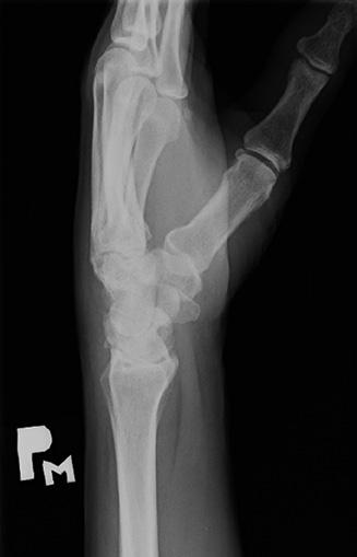 Pri stredne ťažkom postihnutí je dostupné ošetrenie cestou artroskopie zápästia s debridementom a denerváciou karpu.