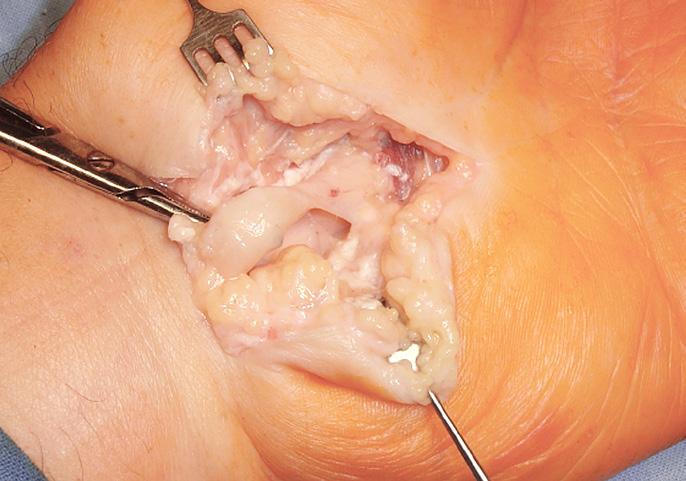 48 Obr. č. 1: Otvorená discízia ligamentum carpi transversum a deliberácia n. medianus v karpálnom kanáli. N. medianus je výrazne zúžený.