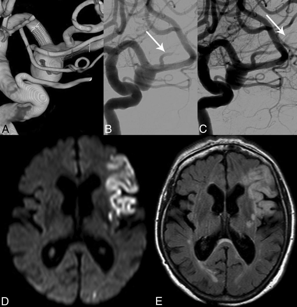 FIG 2. Slow flow within MCA side branch. A, Left MCA aneurysm treated with a PED covering the prefrontal branch. B and C, Slow flow within the covered side branch (arrows).