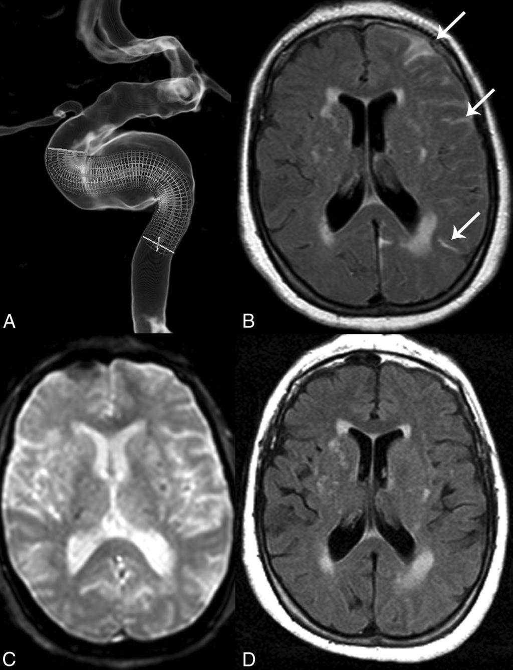 FIG 3. Imaging findings in a patient presenting with cerebral reperfusion syndrome. The patient was treated for a large left carotid cavernous aneurysm with the implantation of 2 overlapped PEDs (A).