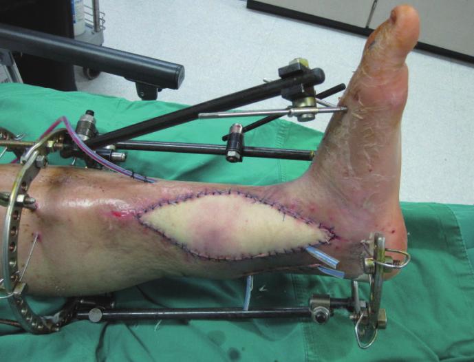 It is a musculocutaneous perforator branching off from the descending branch of the thoracodorsal artery and has a perpendicular course towards the overlying skin.