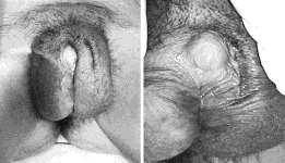 Partial AIS - Micropenis or enlarged clitoris, partial or no closure of scrotum.