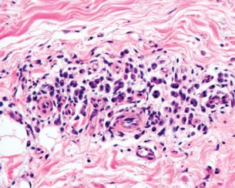 Perivascular Lymphoplasmacytic Infiltrate Acrodermatitis chronica