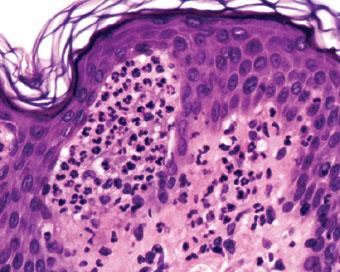 Papillary Micro-abscesses DH / linear IgA dermatitis,