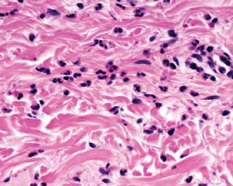 Interstitial Neutrophils in Reticular Dermis Urticaria Cutis laxa DH / linear IgA dermatitis Bullous LE Fixed