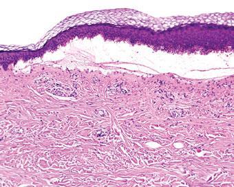 Cell-Poor Subepidermal Blister Suction blister Gas gangrene Porphyria cutanea tarda Bullous dermatosis of hemodialysis Bullous amyloid Blister above scar
