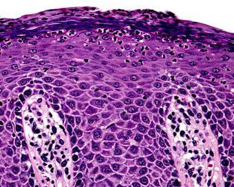 Psoriasiform Dermatitis Neutrophils within