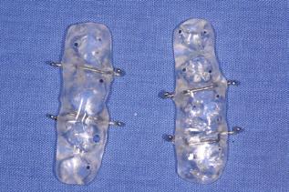 Anterior and posterior hooks were embedded into the buccal and palatal sides of the acrylic blocks for attachment of the coil springs.