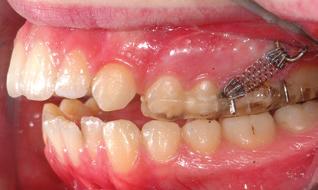 Two miniscrews were inserted into the sides of the palate, 5mm apical to the gingival margins of the first molars.
