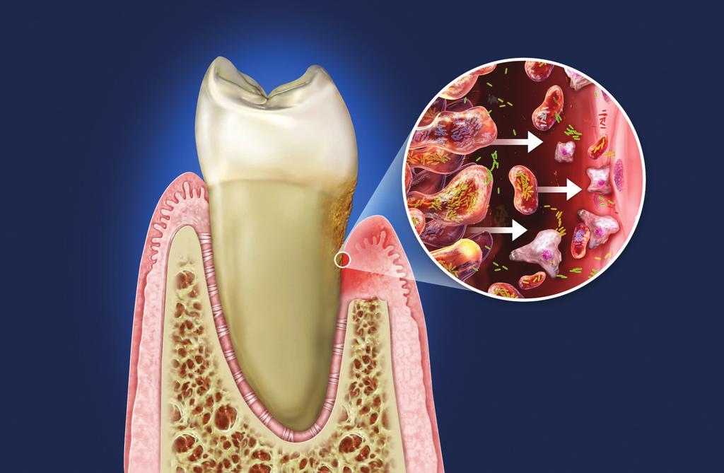 Periodontal disease is a serious infection Periodontal (gum) disease is the most common bacterial infection found anywhere in the body.