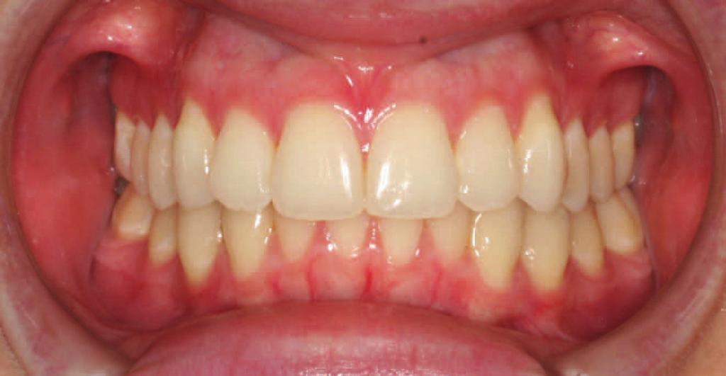 The earlier you treat periodontal disease, the Healthy Gingivitis