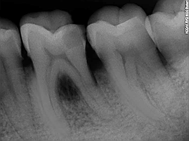 pockets Bone loss Red, swollen gums Bleeding on probing* Pus present* Moderate root exposure Plaque & calculus present* Moderate clinical attachment loss Loose teeth* Clinical Findings 6 mm or